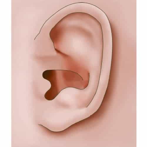 absence anthelix oreille decollee rhinoplastie non chirurgicale otoplastie oreilles decollees chirurgien esthetique paris dc federico loreto centre de medecine esthetique paris