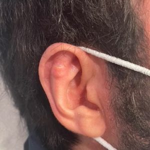 implant earfold non visible earfold paris docteur federico loreto paris chirurgien esthetique visage paris