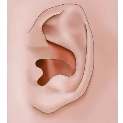 oreille spock ou sthal rhinoplastie non chirurgicale otoplastie oreilles decollees chirurgien esthetique paris dc federico loreto centre de medecine esthetique paris