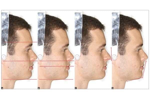 profiloplastie schema visage rhinoplastie genioplastie medicale chirurgicale docteur loreto chirurgien esthetique paris 16