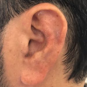 repositionnement implant earfold non visible earfold paris docteur federico loreto paris chirurgien esthetique visage paris