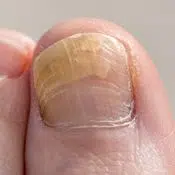 Candidose de l'ongle (mycose) : l'ongle du gros orteil est jaune et se dédouble