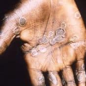Cicatrices suite à la variole du singe sur les mains