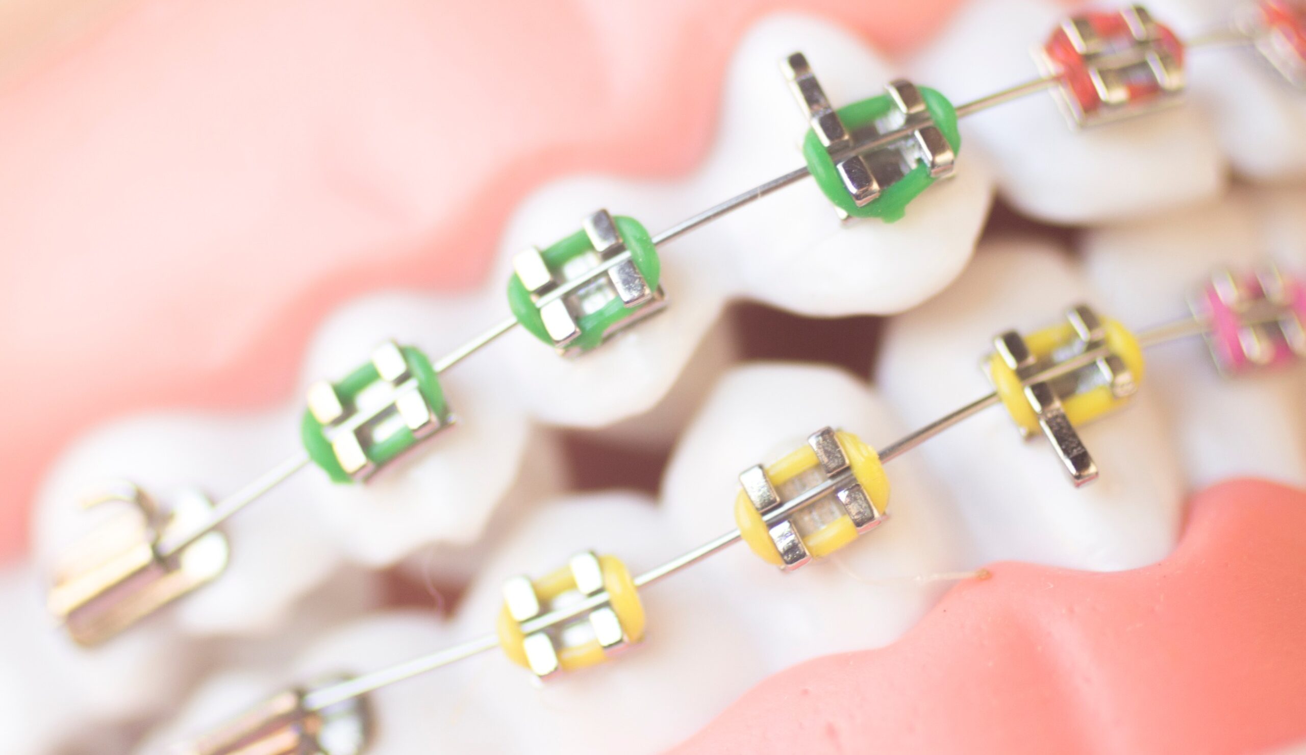 Encombrement dentaire : comprendre les causes, les risques et les solutions